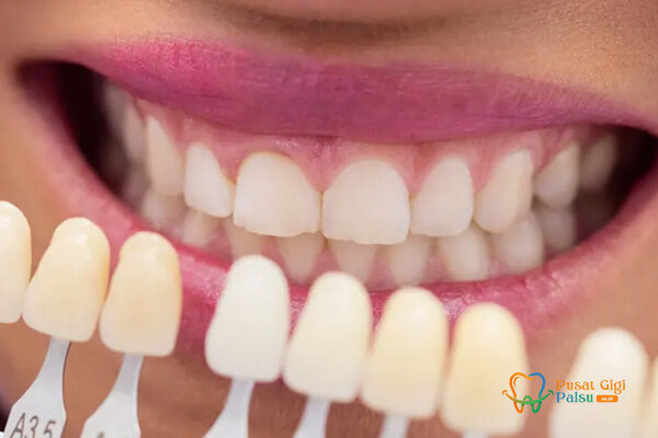 veneer